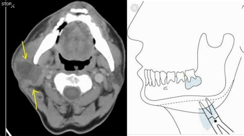 Clinical Anatomy Of Parotid Gland In Just Minutes Anatomy Youtube