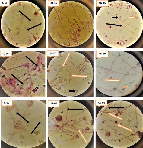 Micro Graphic Pictures Of Sperm Cells At X Shows The Effect Of