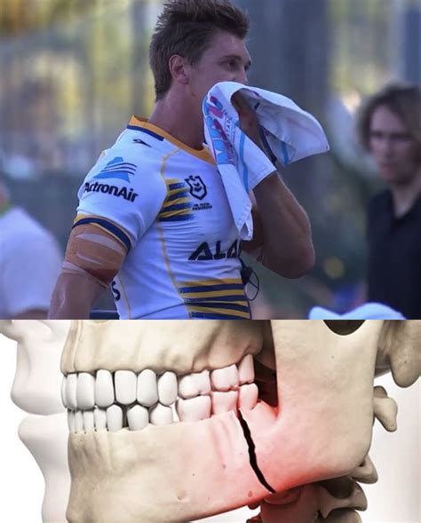 Nrl Physio On Twitter Scans Confirmed A Jaw Fracture For Shaun Lane