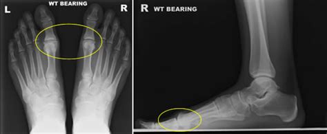 Hallux Rigidus Cheilectomy Surgery | Private Surgeon London | London ...