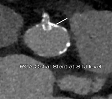 Right coronary artery (RCA) stent protrusion into the aorta at the ...