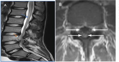 Figure 1 from Spinal brucellosis causing spondylodiscitis | Semantic ...