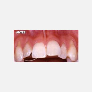 Recesiones gingivales múltiples Clínica Dental Ortoperio