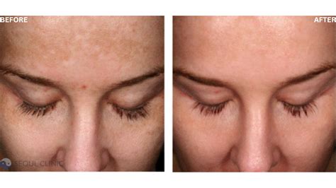 Skin Whitening Treatment Laser Discount