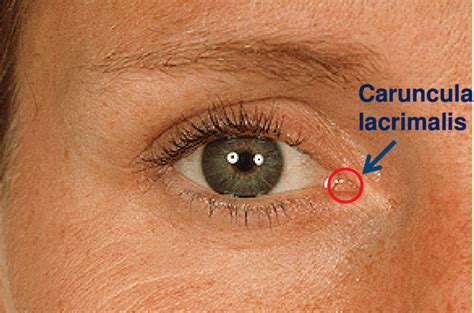 Caruncula lacrimalis - Medicin.wiki
