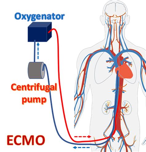 What Is Extracorporeal Cpr Ecpr All About Heart And Blood Vessels