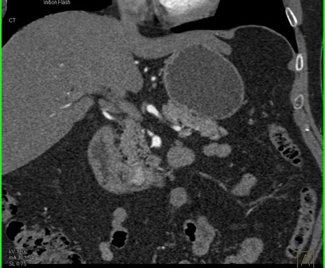 Subtle Vascular Metastases To Pancreas From Renal Cell Carcinoma