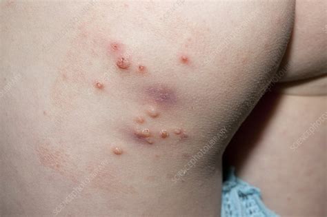 Molluscum Contagiosum Infection Stock Image C Science Sexiz Pix