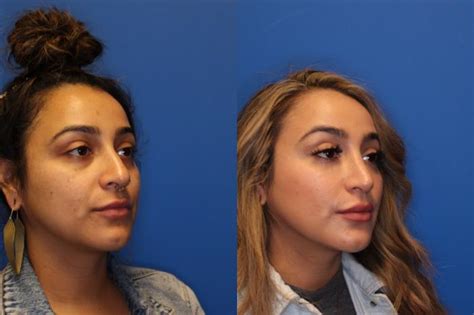 Nose Surgery Before And After Photo Gallery San Francisco Ca Kaiser Permanente Cosmetic Services