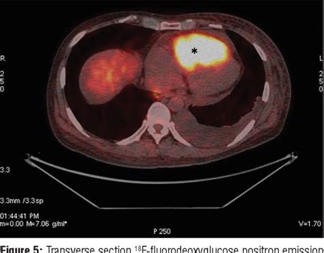 Figure 1 From An Extremely Rare Case Of Carcinoma Rectum Metastasizing To The Heart Semantic