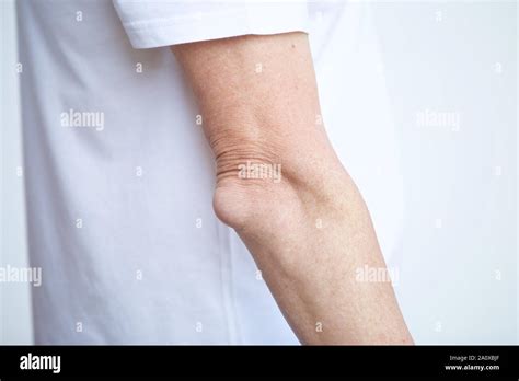 Swelling Associated With Bursitis Of The Elbow Stock Photo Alamy