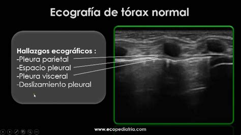 Saturar Gastar Mentalidad Derrame Pleural Laminar Derecho Seguramente