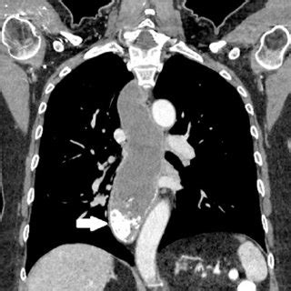 Contrast Enhanced Thoracic Computed Tomography Narrowing Of