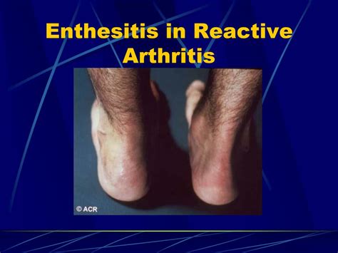 Ppt Clinical Approach To Acute Arthritis Powerpoint Presentation