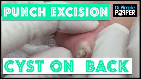 A Recurrent Cyst Removed Via Punch Biopsy Tool Youtube