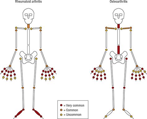 Rheumatoid Arthritis Basicmedical Key