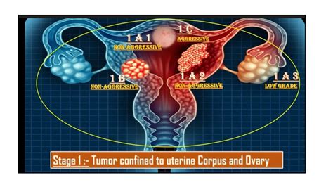 FIGO staging of endometrial cancer: 2023 | PPT | Free Download