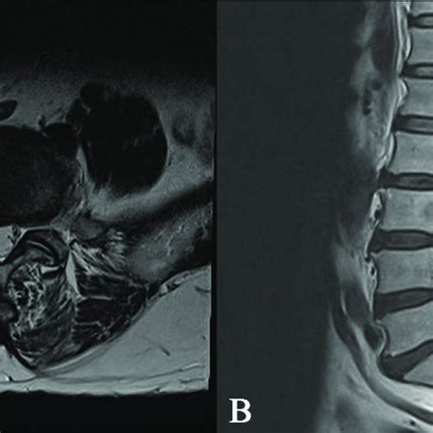 Preoperative T2 Weighted Axial A And Sagittal B Mr Images Without