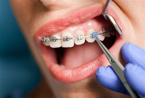 All You Need To Know About Braces 2023 Guide