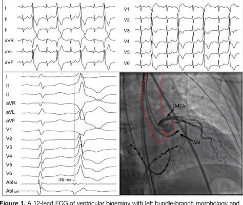 Figure From Catheter Ablation Of Ventricular Tachycardia Semantic