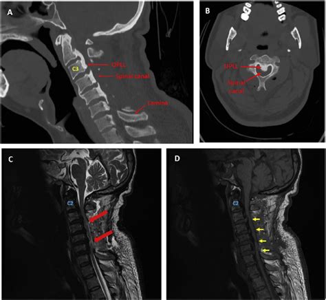 Cervical Vertebrae Anatomy Ct