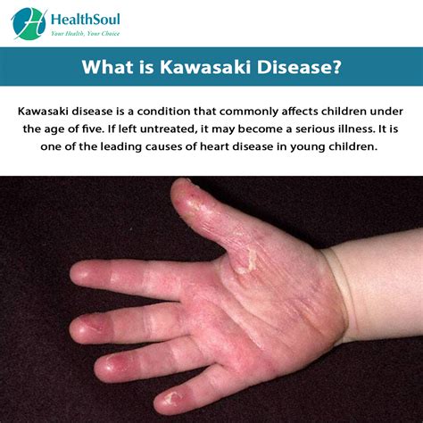 Kawasaki Disease Symptoms