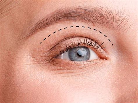 Blefaroplastia Cirurgia De P Lpebras Clinica San Martin Cirurgia