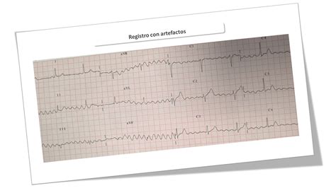 ECG Artefactado Cardioprimaria Ferrol