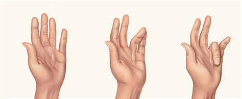 Dupuytrens Contracture Treatment Miami Hand Center