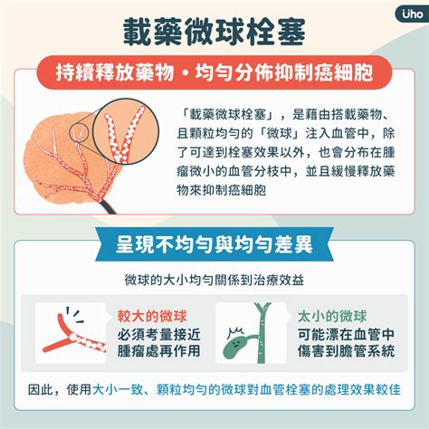 降期治療法＋載藥微球栓塞，新治療策略讓晚期肝癌患者有機會換肝重生uho優活健康網