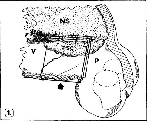 Figure 1 From Histology Of The Premaxillary Vomerine Suture In A Bilateral Cleft Case