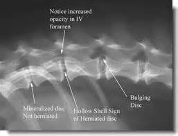 "Slipped Disc" Disease In Dogs