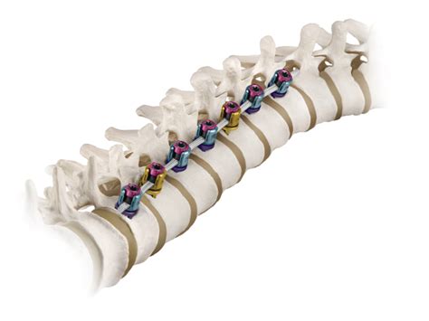 Vertebral Body Tethering Scoliosis Texas