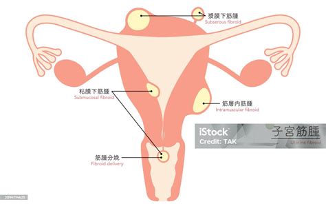 Diagrammatic Illustration Of Uterine Fibroids Anatomy Of The Uterus And