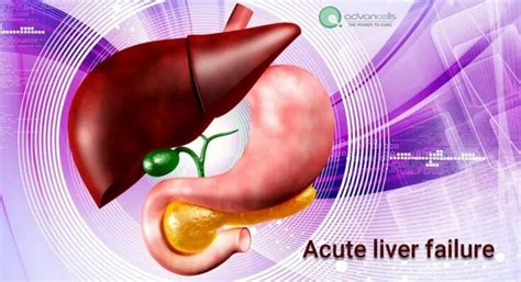 Acute Liver Failure Diagnosis And Treatment