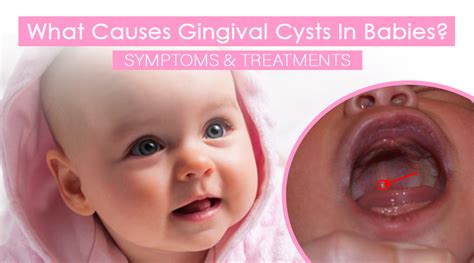 Gingival Cyst Of The Newborn