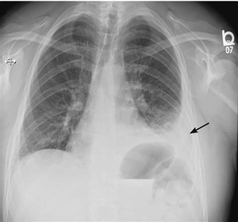 Rapidly Progressive Pleural Effusion Cleveland Clinic Journal Of Medicine