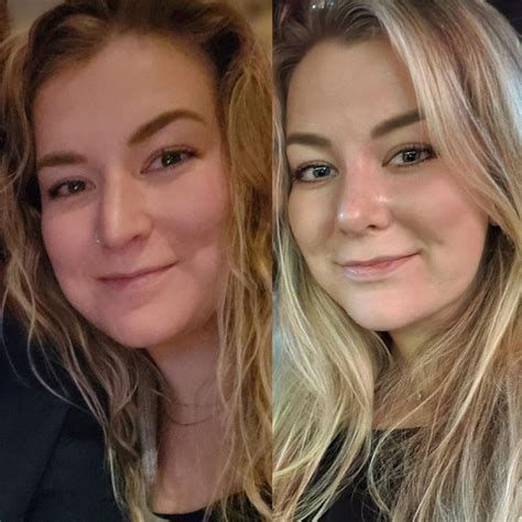 3 Weeks Post Op Rhinoplasty And Submental Lipo Rplasticsurgery