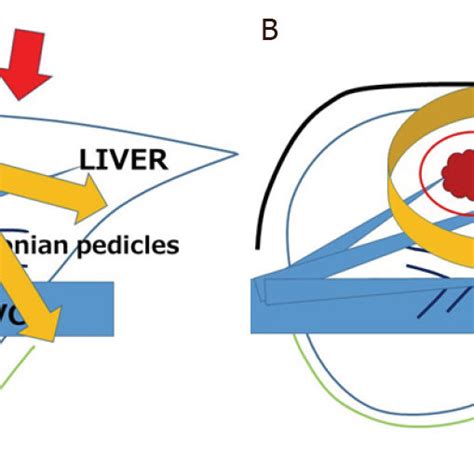 Open A And Laparoscopic B Repeat Liver Resections The Directions