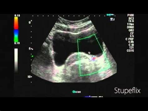 cochinblogs: Twinkle (color Doppler) artifacts in urinary calculi