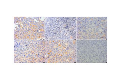 Los macrófagos se perfilan como diana terapéutica en el cáncer de