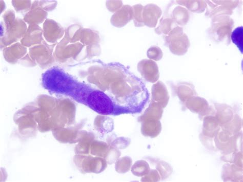 Histology Of Bone Marrow Aspirate Macrophage Engulfing Erythrocytes