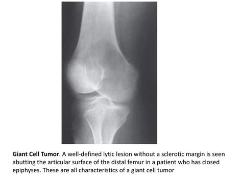 Lytic Lesions Of Bone Ppt