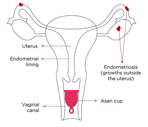 Can Menstrual Cups Cause A Prolapsed Uterus At Gena Francis Blog