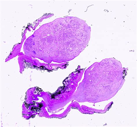 Intravenous Lobular Capillary Hemangioma Annals Of Vascular Surgery