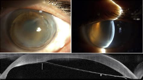 “descemet Membrane Detachment” A Novel Concept In Diagnosis And Classification American