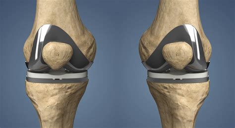 Bilateral Vs Single Side Total Knee Replacement UnderstandOrtho