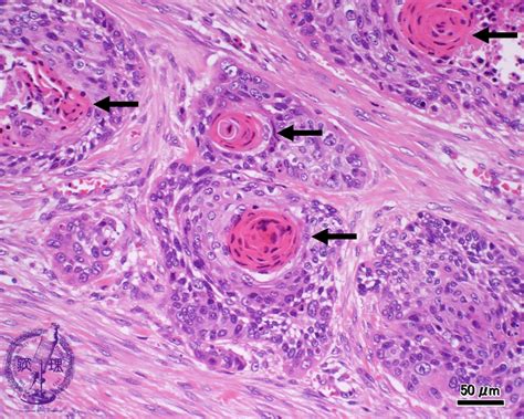 Squamous Cell Carcinoma Histology