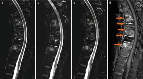 Ankylosing Spondylitis Radiology Key