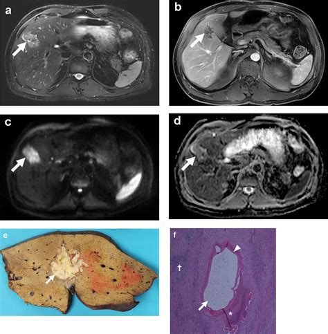 Alveolar Echinococcosis Of The Liver Diffusion Weighted Mri Findings And Potential Role In